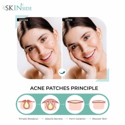 Skinside Acne Pimple Patches for Face Pimples Hydrocolloid Facial Patches with 0.5% Salicylic Acid for Pimple Healing